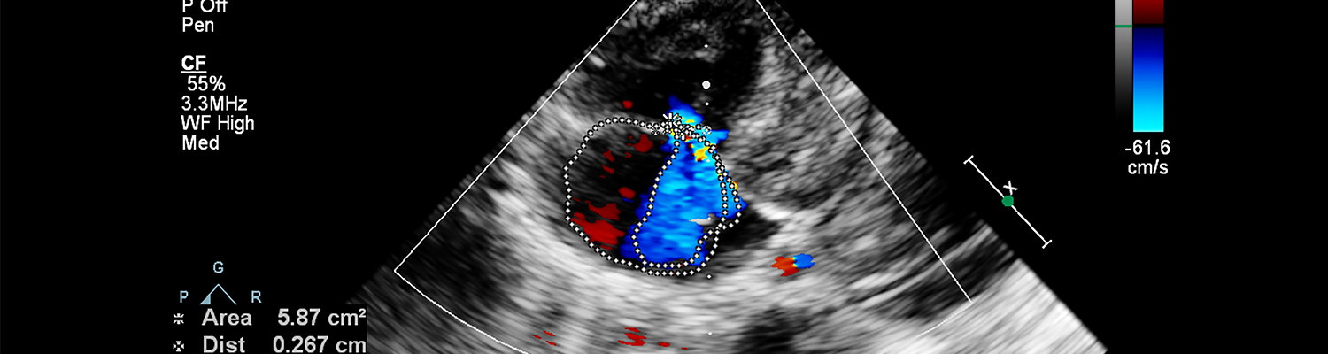 Image of the heart during transesophageal ultrasound with Doppler mode