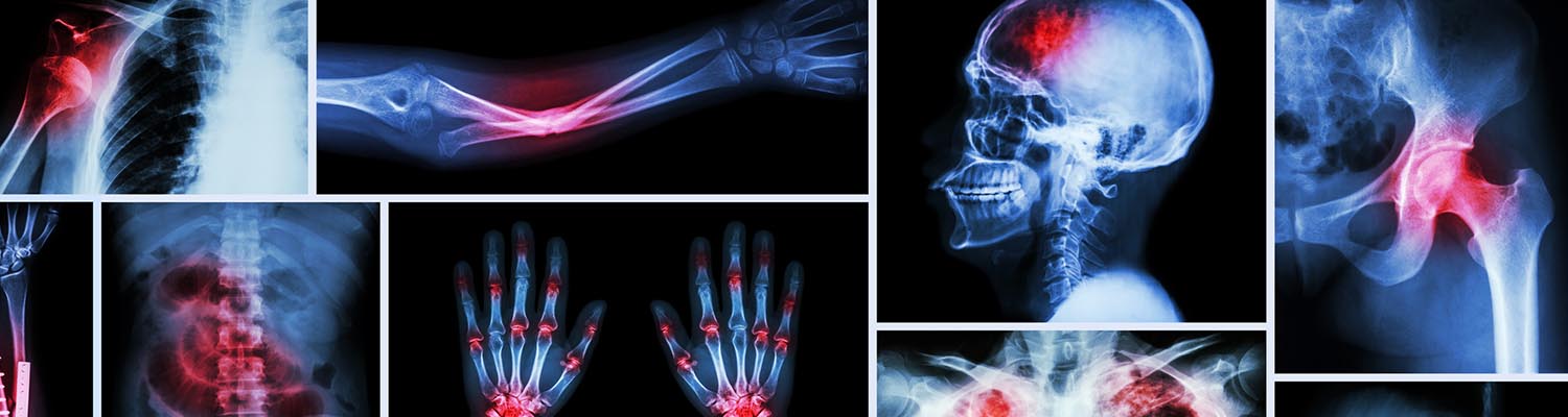 X-ray images of joints in arm and hands with areas glowing in red