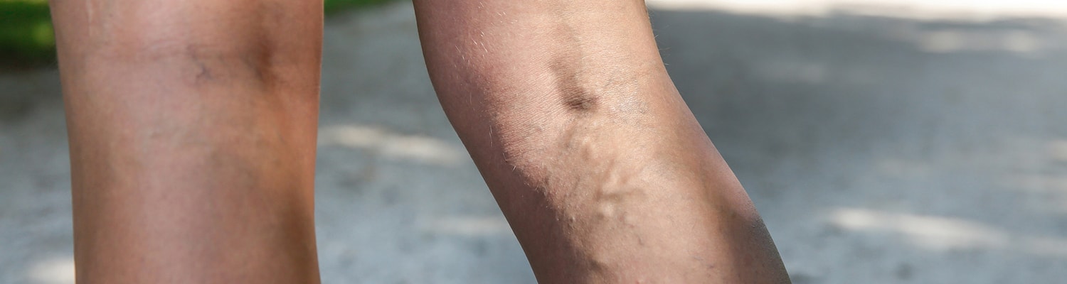 Back of persons legs with some prominent veins outdoors people walking in distance.